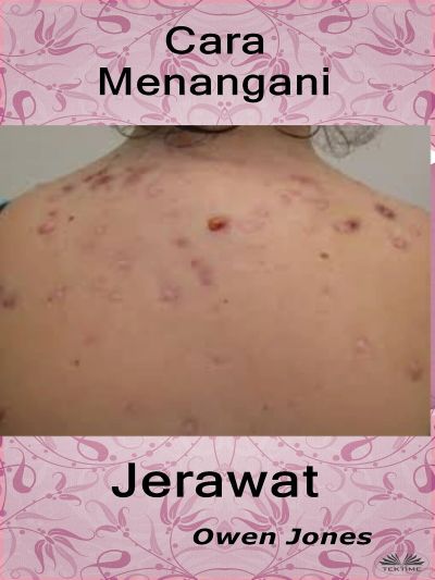 Cara Menangani Jerawat
